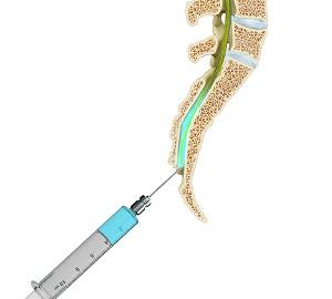 Caudal Epidural Injection