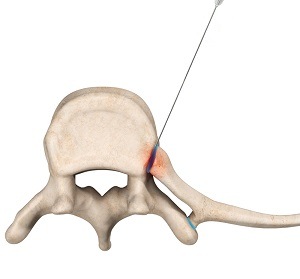 Costo-vertebral Joint Injection