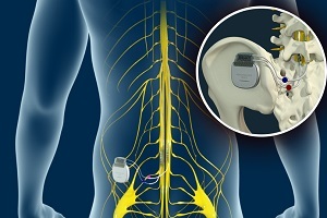 Dorsal Column Stimulator