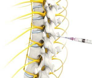 Epidural Steroid Injections