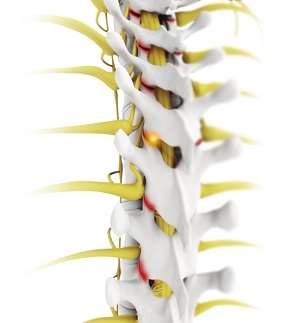 Facet Joint Arthritis