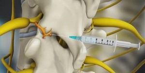 Medial Branch Block Injections