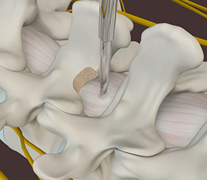 MILD Procedure - Minimally Invasive Lumbar Decompression