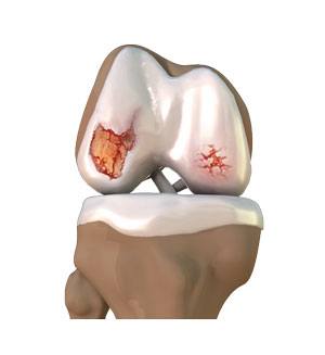 Osteoarthritis Management