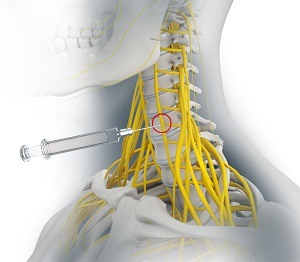 Occipital & Peripheral Nerve Blocks