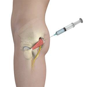 Piriformis Muscle Injection