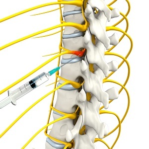 Selective Nerve Block