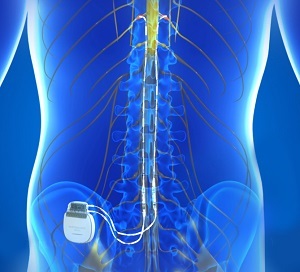 Utilizing a Double Epidural Electrical Stimulation Implant For SCI