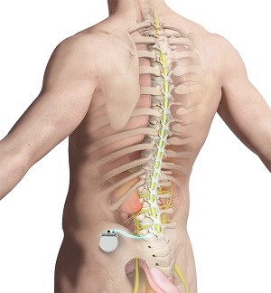 Spinal Cord Stimulator South County, Back Pain