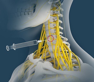 Stellate Ganglion Block