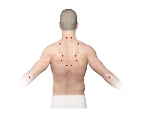 Trigger Point Injections